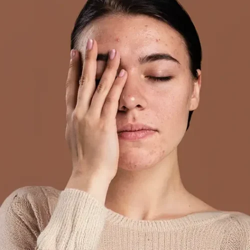 Pelle grassa e acne: cause, rimedi e la skincare migliore